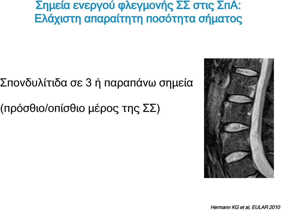 Σπονδυλίτιδα σε 3 ή παραπάνω σηµεία