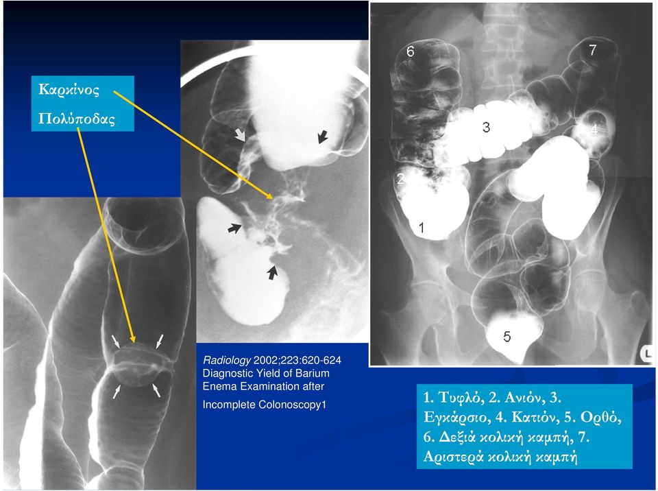 Incomplete Colonoscopy1 1. Τυφλό, 2. Ανιόν, 3.