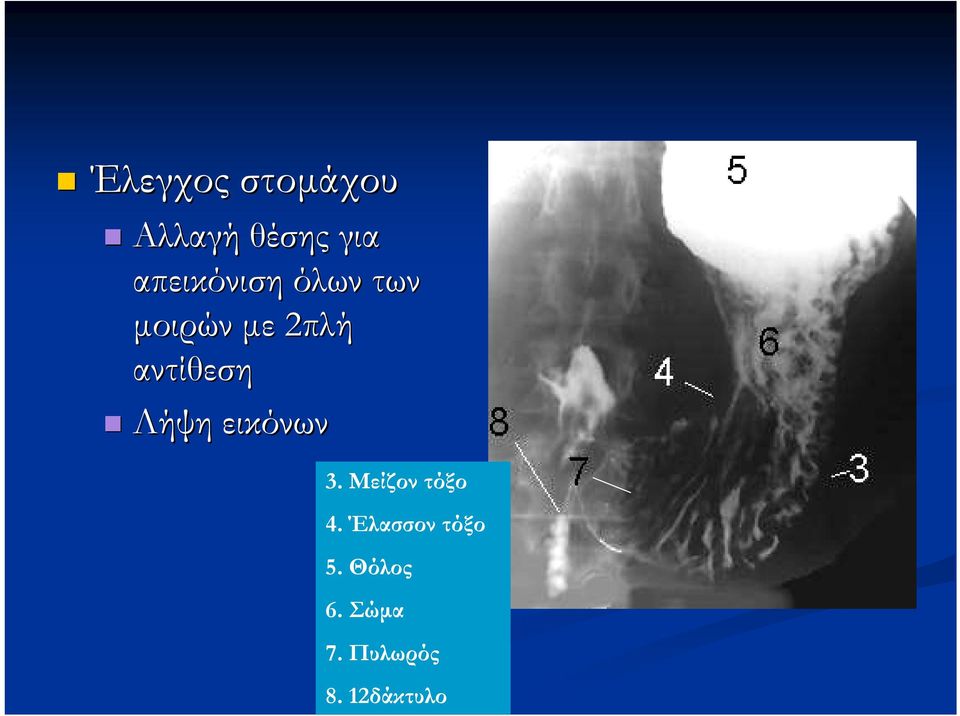 αντίθεση Λήψη εικόνων 3. Μείζον τόξο 4.