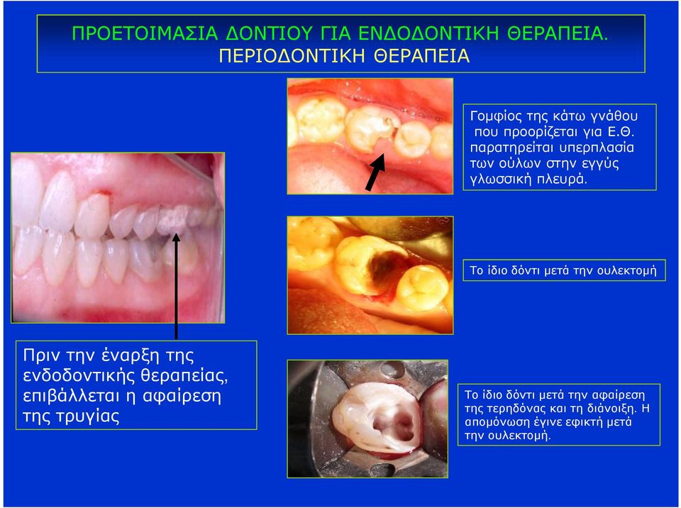 Το ίδιο δόντι μετά την ουλεκτομή Πριν την έναρξη της ενδοδοντικής θεραπείας, επιβάλλεται η αφαίρεση