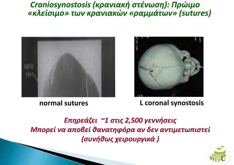 coronal synostosis Επηρεάζει ~1 στις 2,500 γεννήσεις