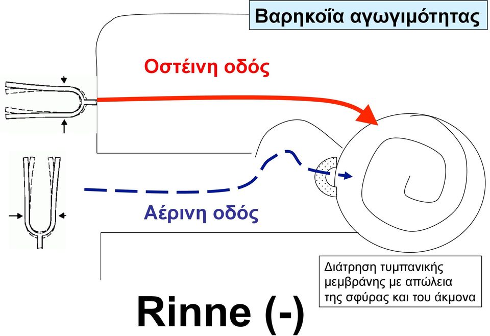 (-) Διάτρηση τυµπανικής