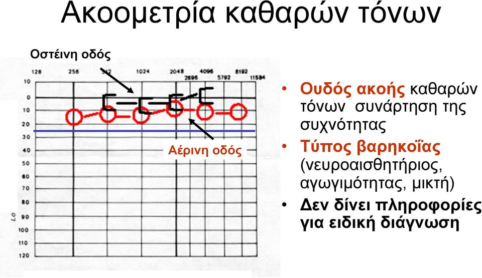 συχνότητας Τύπος βαρηκοΐας (νευροαισθητήριος,
