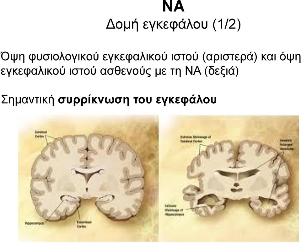 (αριστερά) και όψη εγκεφαλικού ιστού