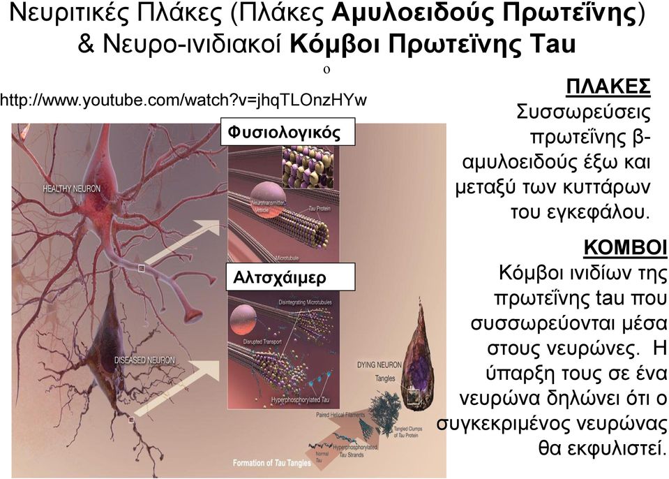 v=jhqtlonzhyw Φυσιολογικός Αλτσχάιμερ ΠΛΑΚΕΣ Συσσωρεύσεις πρωτεΐνης β- αμυλοειδούς έξω και μεταξύ