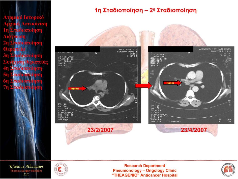 tumor