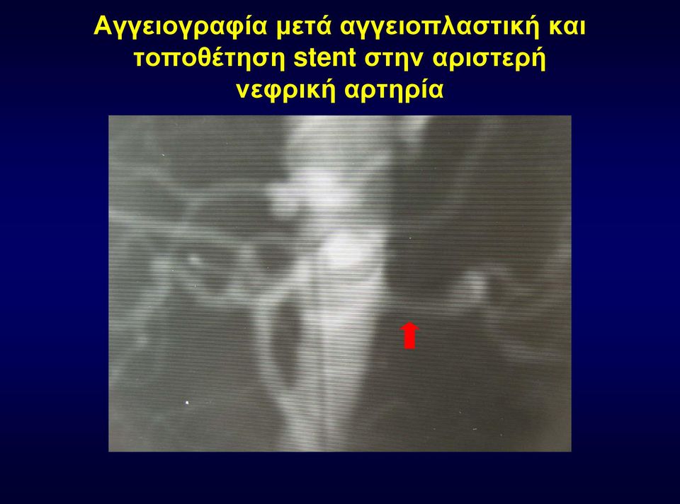 τοποθέτηση stent