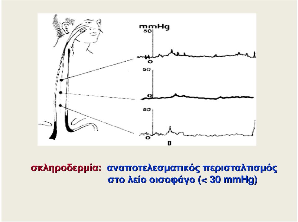 περισταλτισµός στο