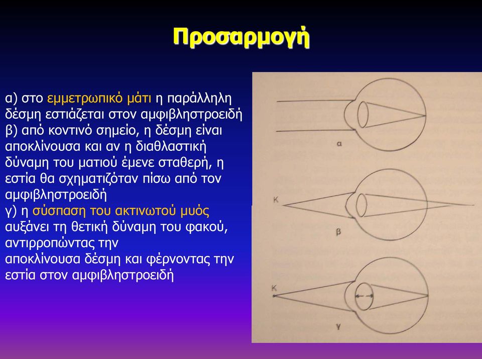 εστία θα σχηματιζόταν πίσω από τον αμφιβληστροειδή γ) η σύσπαση του ακτινωτού μυός αυξάνει τη