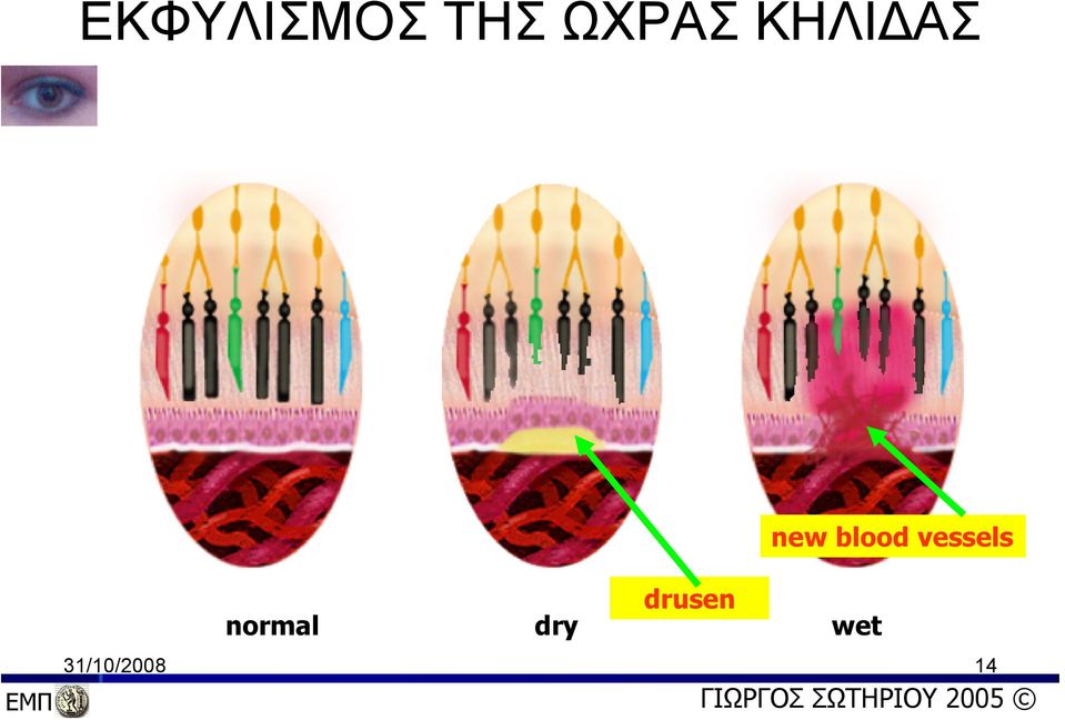 dry wet new blood vessels