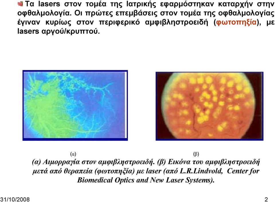 (φωτοπηξία), με lasers αργού/κρυπτού. (α) (α) Αιμορραγία στον αμφιβληστροειδή.