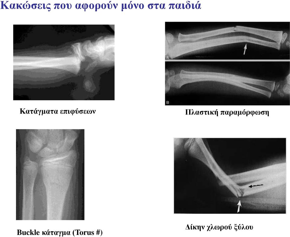 Πλαστική παραμόρφωση Buckle