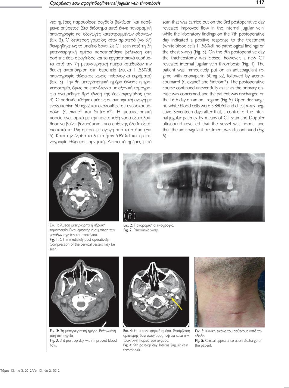 Σε CT scan κατά τη 3η µετεγχειρητική ηµέρα παρατηρήθηκε βελτίωση στη ροή της έσω σφαγίτιδος και τα εργαστηριακά ευρήµατα κατά την 7η µετεγχειρητική ηµέρα κατέδειξαν την θετική ανταπόκριση στη