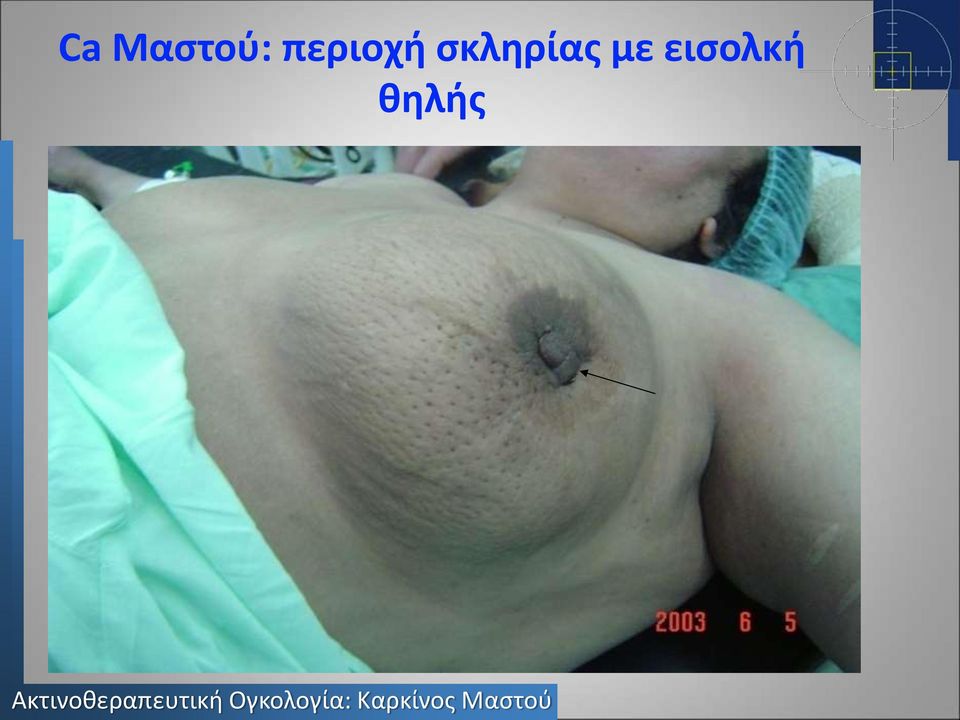 σκληρίας