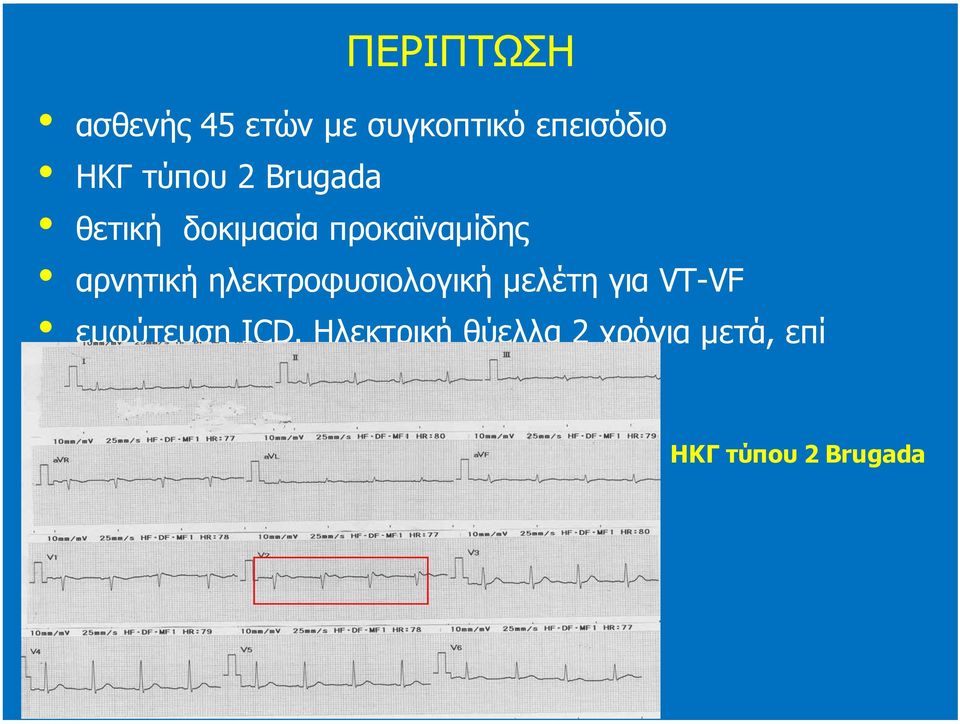 ηλεκτροφυσιολoγική µελέτη για VT-VF εµφύτευση ICD.