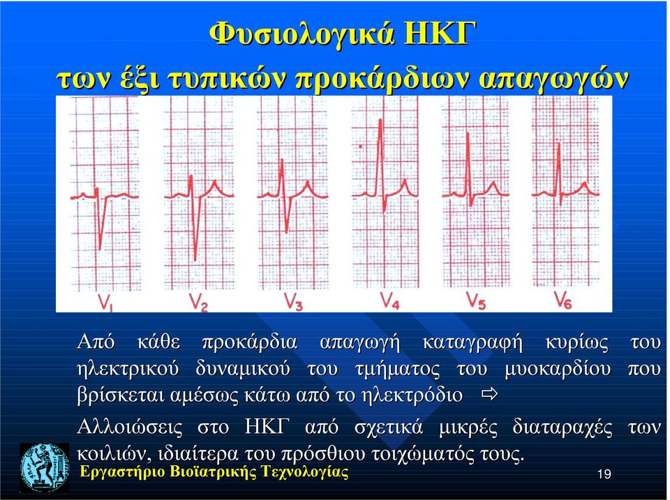 μυοκαρδίου που βρίσκεται αμέσως κάτω από το ηλεκτρόδιο " Αλλοιώσεις στο