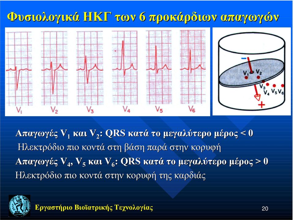 βάση παρά στην κορυφή Απαγωγές V 4, V 5 και V 6 : QRS κατά το
