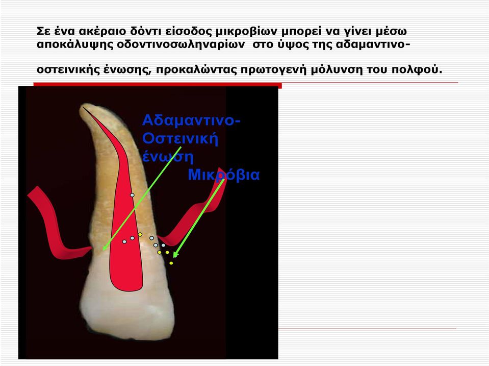 της αδαμαντινοοστεινικής ένωσης, προκαλώντας