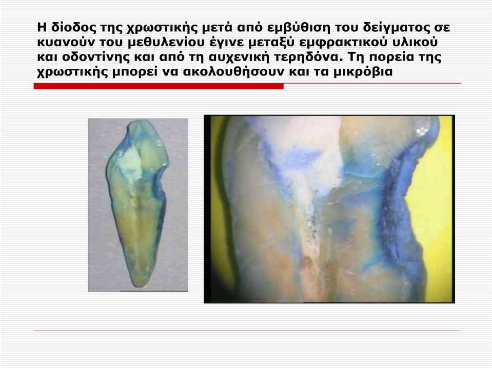 υλικού και οδοντίνης και από τη αυχενική τερηδόνα.