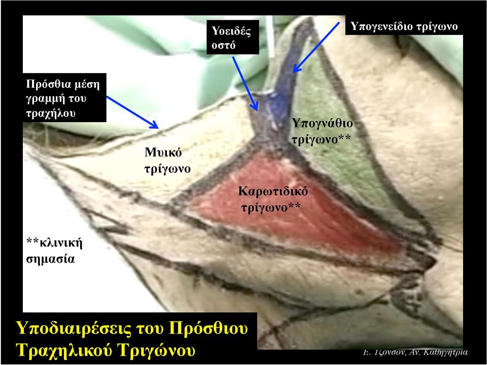 τρίγωνο Καρωτιδικό τρίγωνο** **κλινική σηµασία