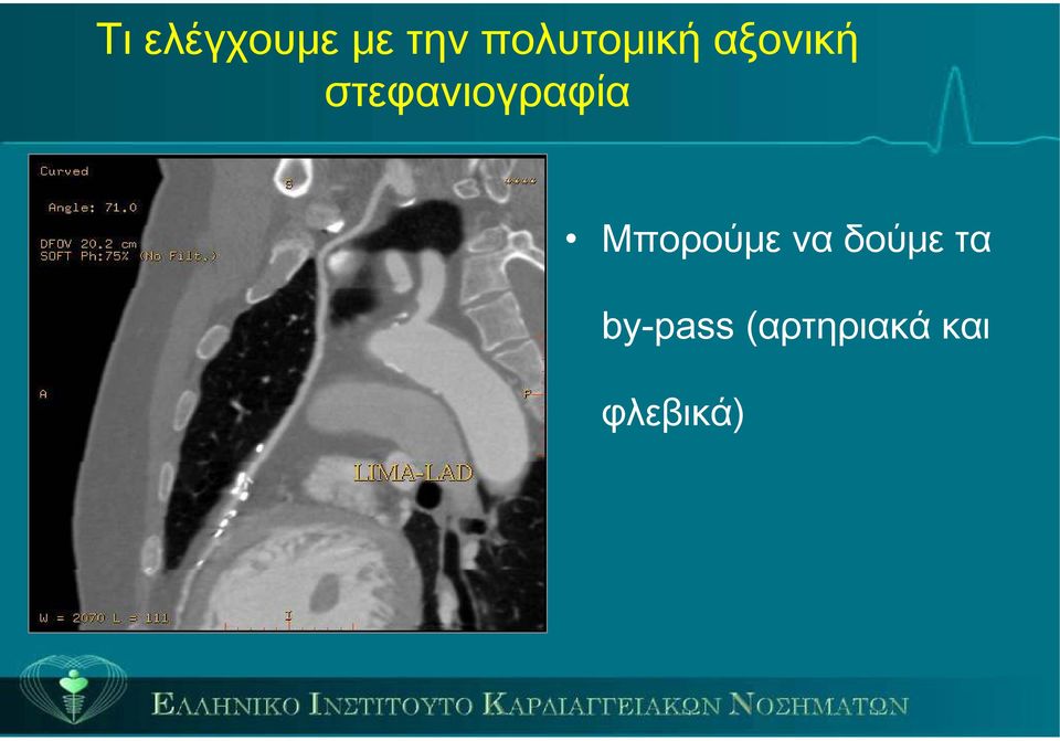 στεφανιογραφία Μπορούμε να