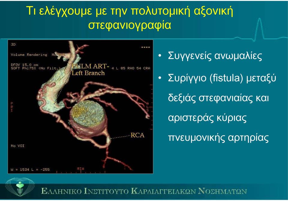 Συρίγγιο (fistula) μεταξύ δεξιάς