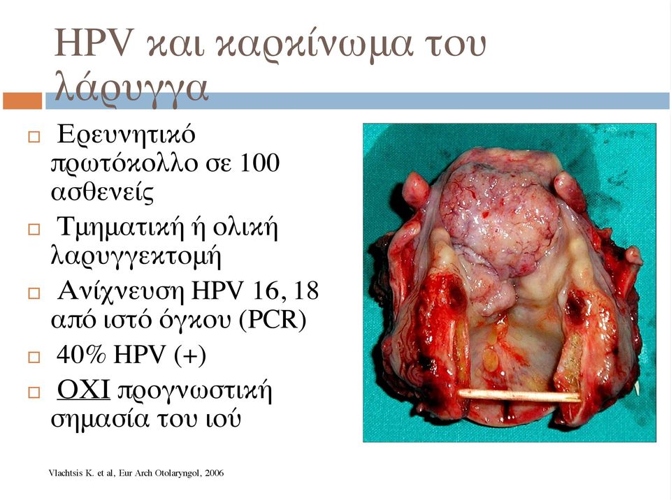 16, 18 από ιστό όγκου (PCR) 40% HPV (+) ΟΧΙ προγνωστική
