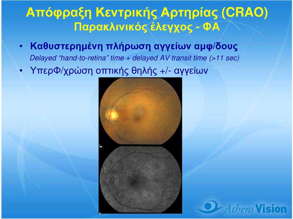 αµφ/δους Delayed hand-to-retina time + delayed AV