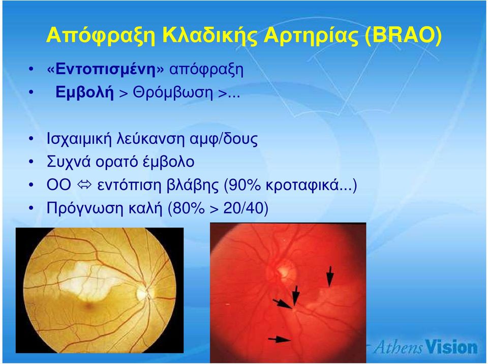 .. Ισχαιµική λεύκανση αµφ/δους Συχνά ορατό