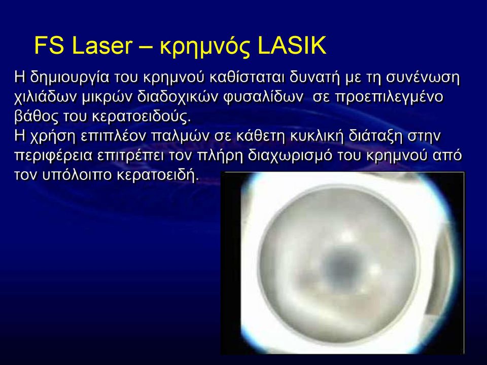 LASIK