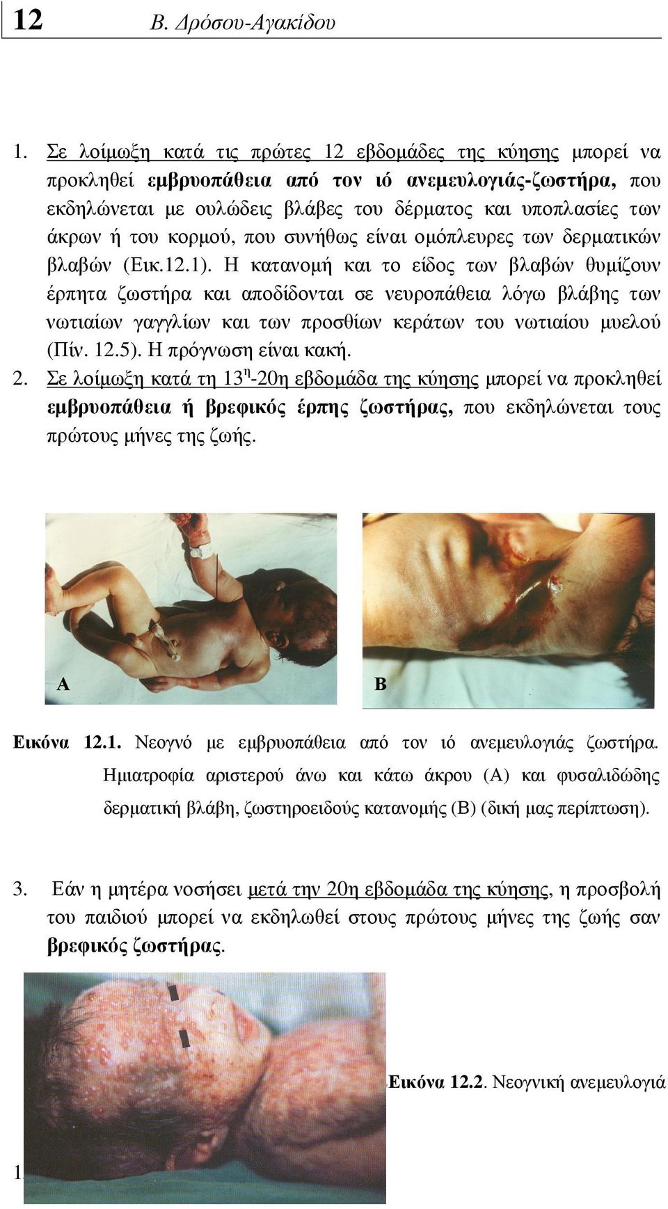 Η κατανοµή και το είδος των βλαβών θυµίζουν έρπητα ζωστήρα και αποδίδονται σε νευροπάθεια λόγω βλάβης των νωτιαίων γαγγλίων και των προσθίων κεράτων του νωτιαίου µυελού (Πίν. 12.5).