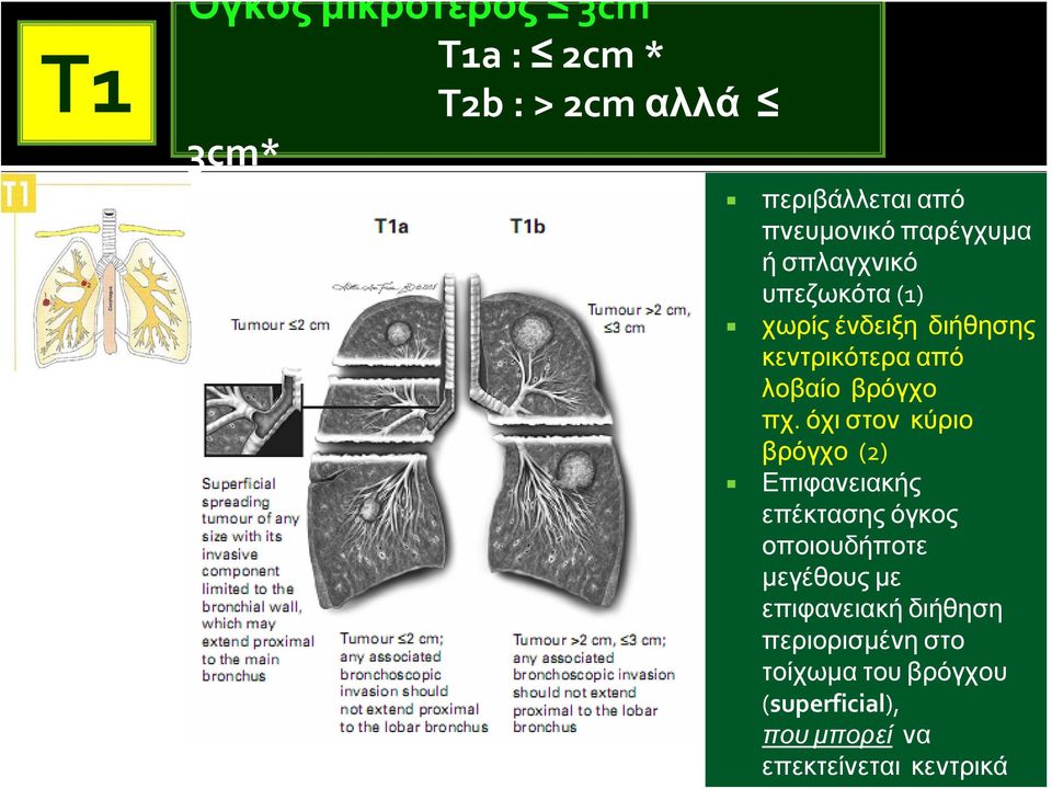 πχ. όχι στον κύριο βρόγχο (2) Επιφανειακής επέκτασης όγκος οποιουδήποτε μεγέθους με