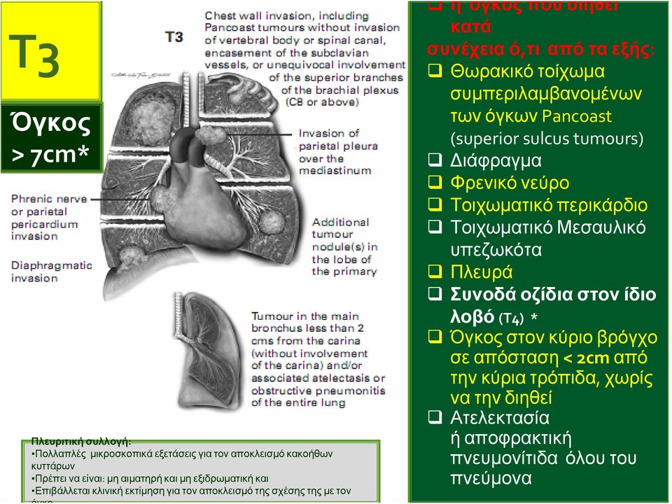 συμπεριλαμβανομένων των όγκων Pancoast (superior sulcus tumours) Διάφραγμα Φρενικό νεύρο Τοιχωματικό περικάρδιο Τοιχωματικό Μεσαυλικό υπεζωκότα Πλευρά