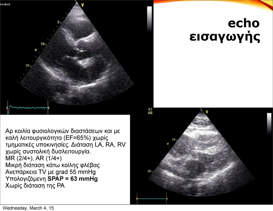 Διάταση LA, RA, RV χωρίς συστολική δυσλειτουργία.