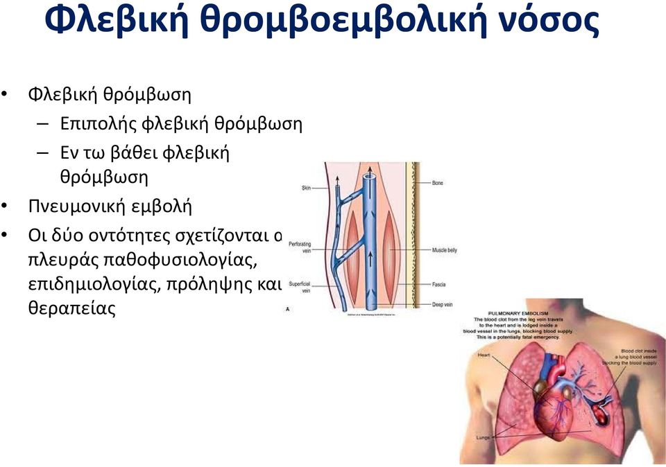 θρόμβωση Πνευμονική εμβολή Οι δύο οντότητες