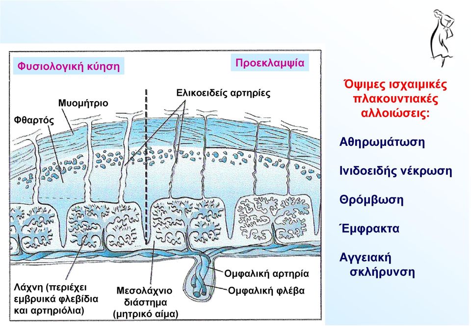 Θρόμβωση Έμφρακτα Λάχνη (περιέχει εμβρυικά φλεβίδια και αρτηριόλια)