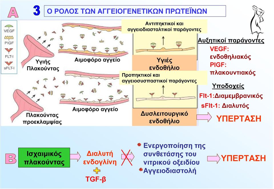 Δυσλειτουργικό ενδοθήλιο Αυξητικοί παράγοντες VEGF: ενδοθηλιακός PlGF: πλακουντιακός Υποδοχείς Flt-1:Διαμεμβρανικός