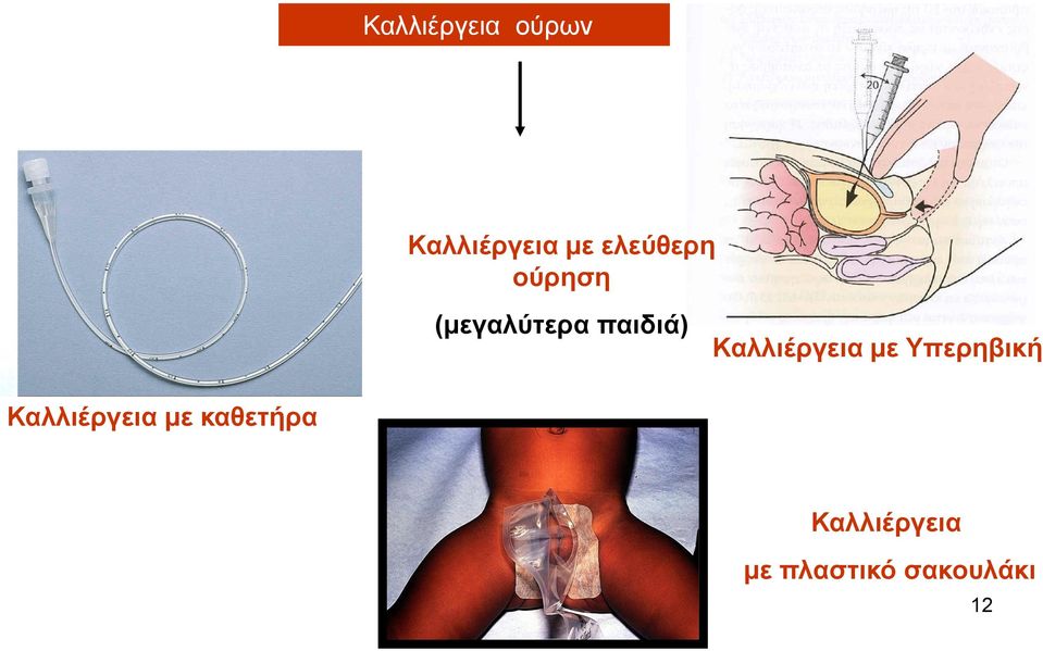 Καλλιέργεια με Υπερηβική Καλλιέργεια