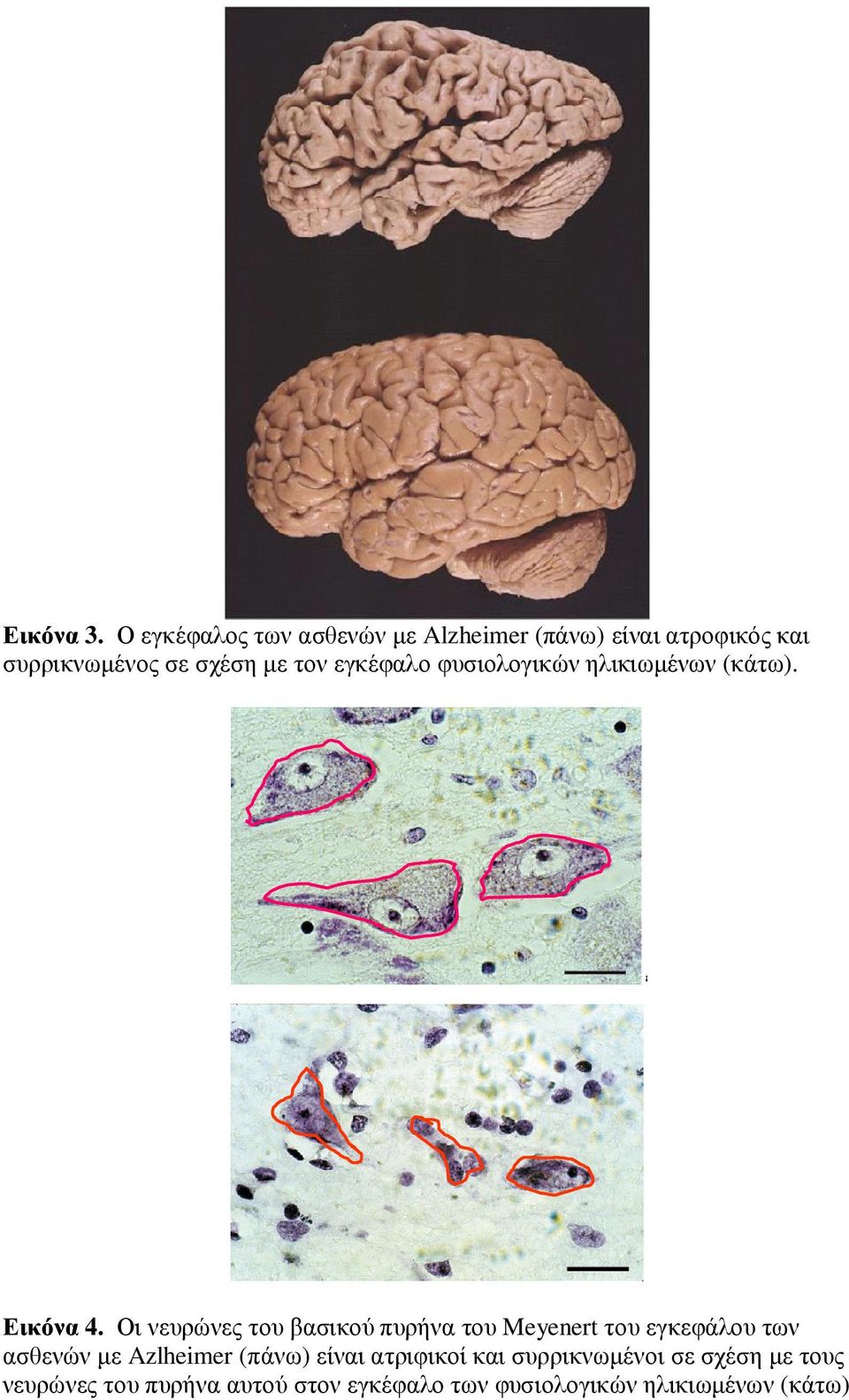 τον εγκέφαλο φυσιολογικών ηλικιωµένων (κάτω). Εικόνα 4.