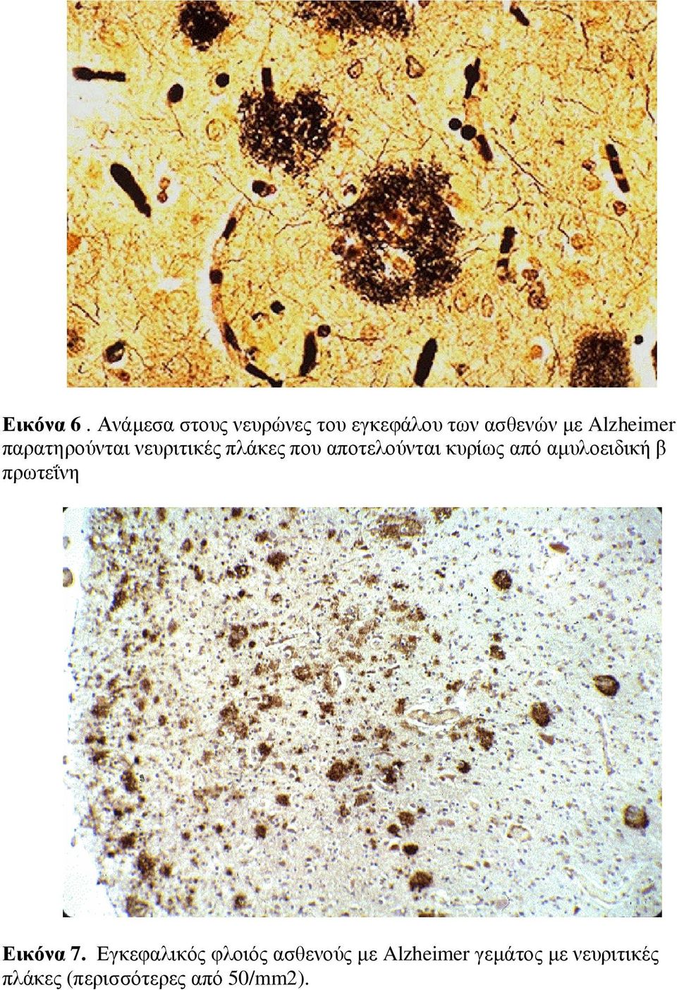 παρατηρούνται νευριτικές πλάκες που αποτελούνται κυρίως από