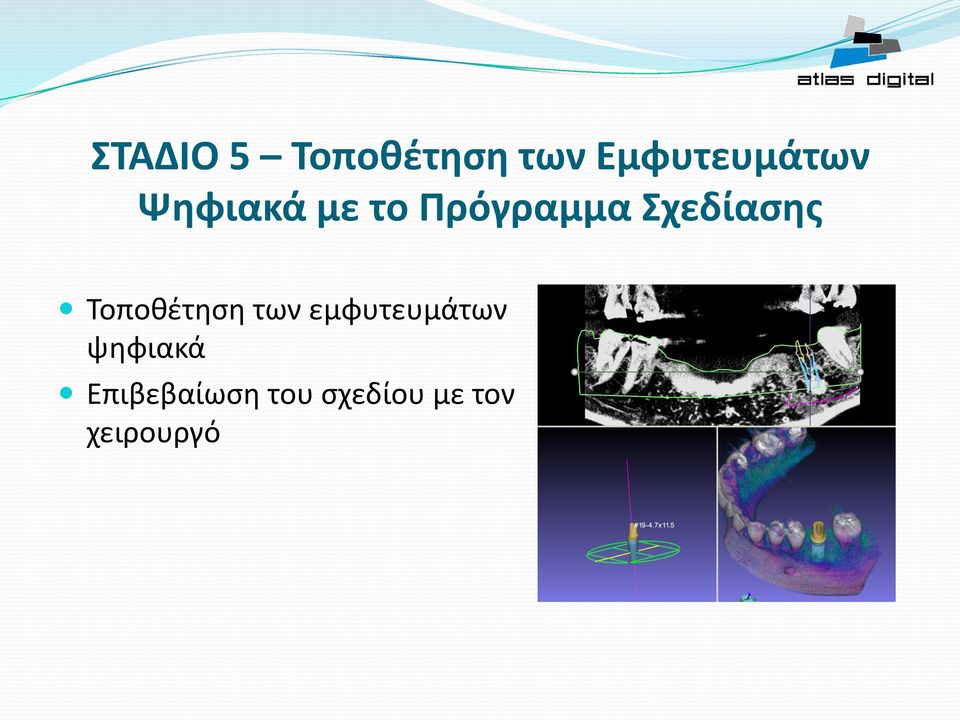 Τοποθέτηση των εμφυτευμάτων ψηφιακά