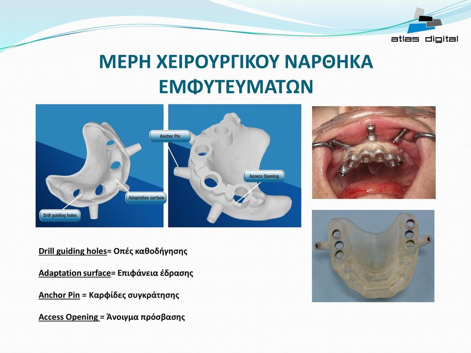 surface= Επιφάνεια έδρασης Anchor Pin =