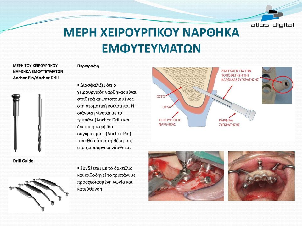 Η διάνοιξη γίνεται με το τρυπάνι (Anchor Drill) και έπειτα η καρφίδα συγκράτησης (Anchor Pin) τοποθετείται στη