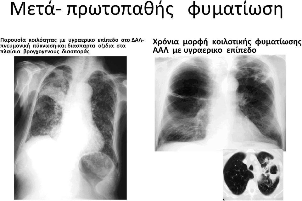 διασπαρτα οζιδια στα πλαίσια βρογχογενους διασποράς