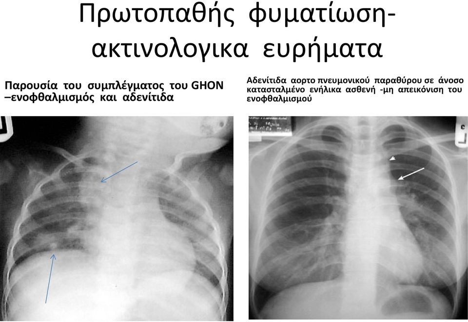 αδενίτιδα Αδενίτιδα αορτο πνευμονικού παραθύρου σε