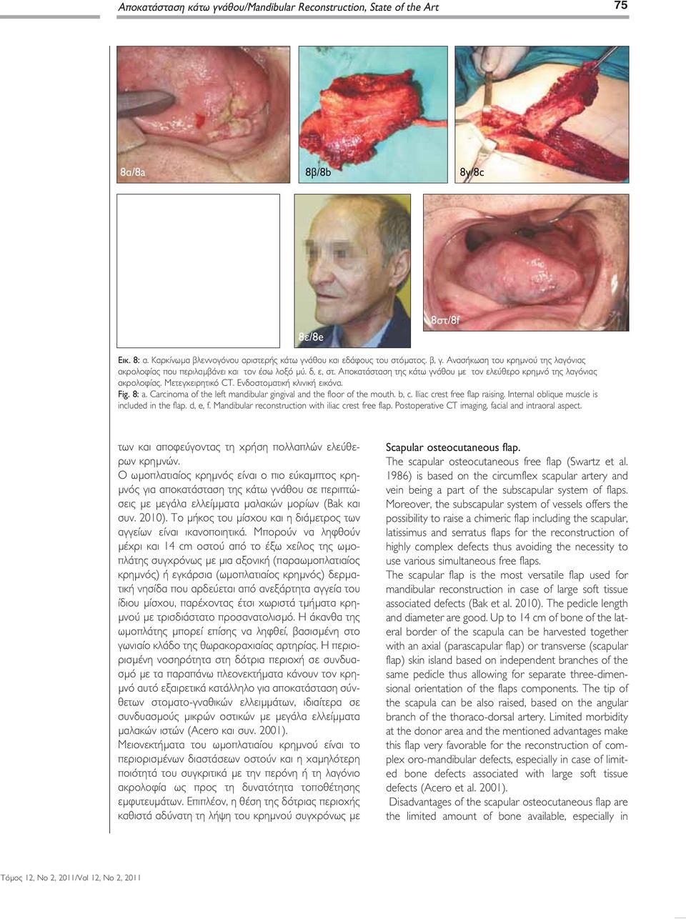 Ενδοστοματική κλινική εικόνα. Fig. 8: a. Carcinoma of the left mandibular gingival and the floor of the mouth. b, c. Iliac crest free flap raising. Internal oblique muscle is included in the flap.