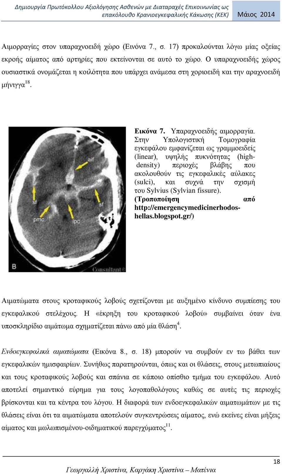 Στην Υπολογιστική Τομογραφία εγκεφάλου εμφανίζεται ως γραμμοειδείς (linear), υψηλής πυκνότητας (highdensity) περιοχές βλάβης που ακολουθούν τις εγκεφαλικές αύλακες (sulci), και συχνά την σχισμή του