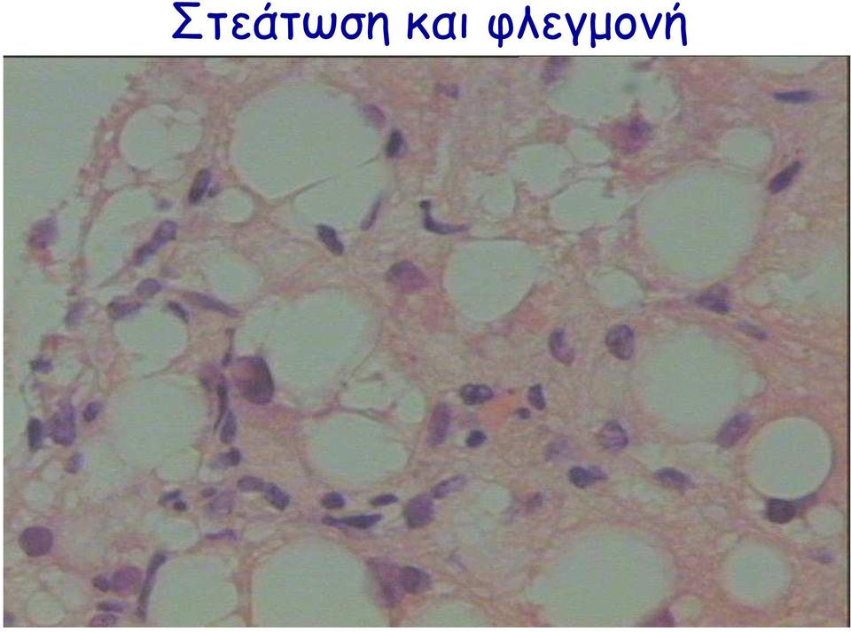 φλεγµονή