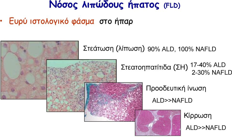 NAFLD Στεατοηπατίτιδα (ΣΗ) 17-40% ALD 2-30%