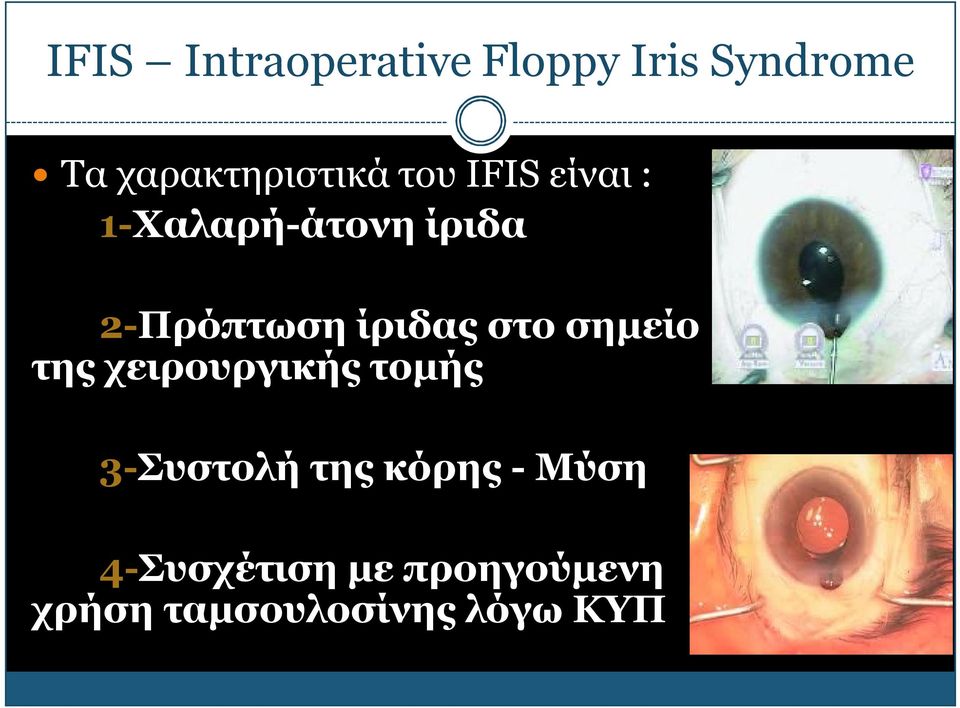 2-Πρόπτωση ίριδας στο σημείο της χειρουργικής τομής
